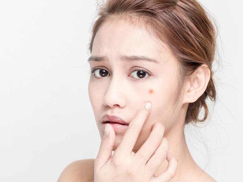ĐỪNG HỎI VÌ SAO MỤN NỔI LIÊN TỤC NẾU LÂU RỒI BẠN KHÔNG LÀM VIỆC NÀY