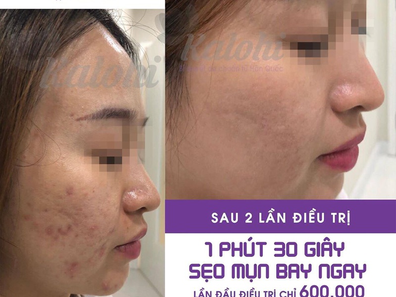 ĐÁNH TAN VẾT THÂM MỤN NGAY TẠI NHÀ LÀN DA TRẮNG SÁNG TRÔNG THẤY