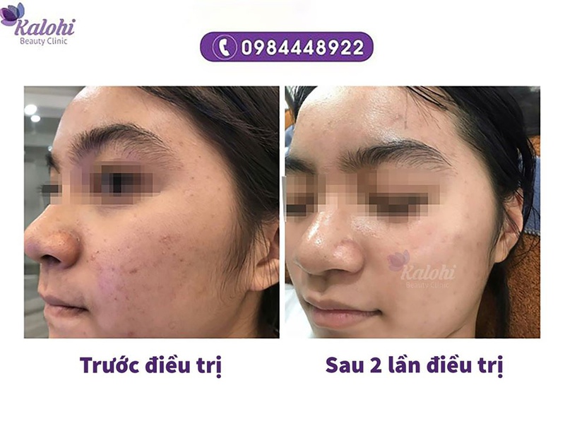GIÚP BẠN THOÁT KHỎI CƠN ÁC MỘNG SẸO RỖ LÂU NĂM