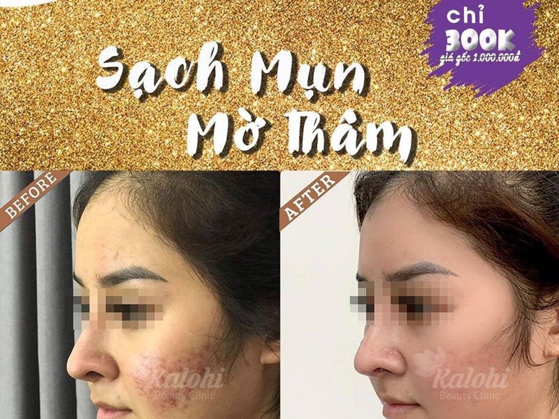 NỖI ÁM ẢNH CỦA CHỊ EM PHỤ NỮ “ MỤN”