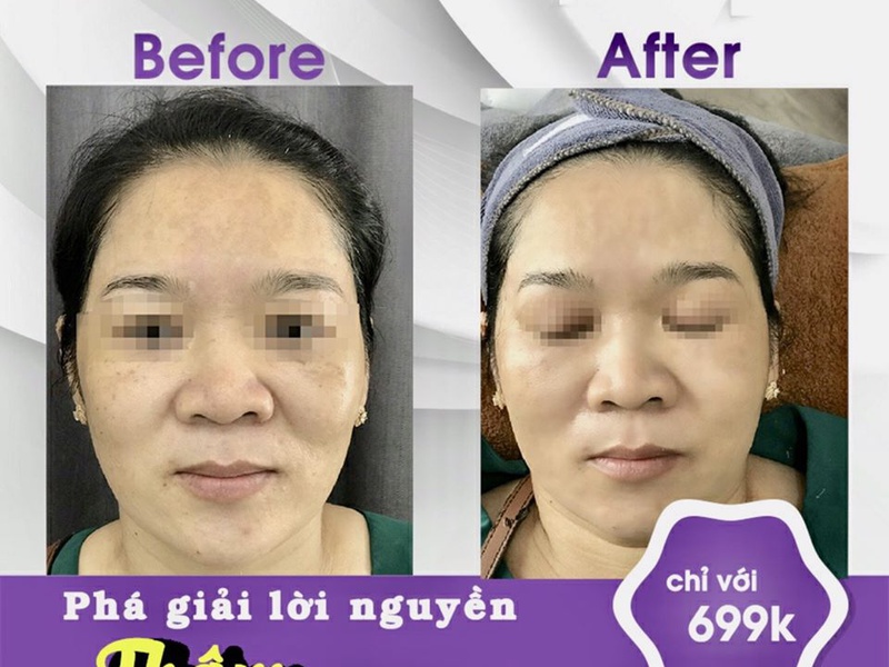 KHẮC PHỤC LÀN DA THÂM SẠM KHÔNG ĐỀU MÀU NHANH CHÓNG CÙNG KALOHI BEAUTY